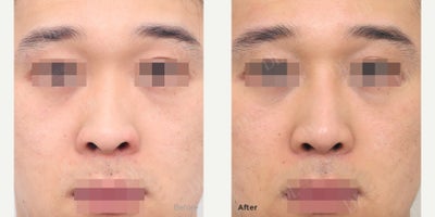 Eyelid Surgery before and after photo