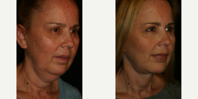 Facelift before and after photo