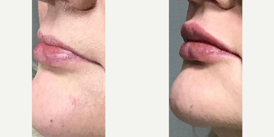 Juvederm before and after photo