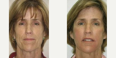 Sculptra before and after photo