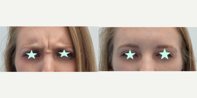 Botox before and after photo
