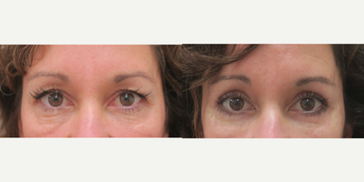 Eyelid Surgery before and after photo