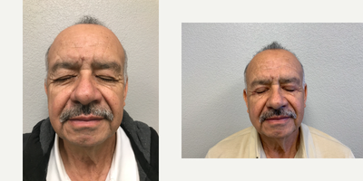 Eyelid Surgery before and after photo