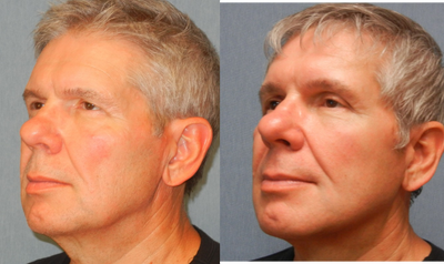Facelift before and after photo