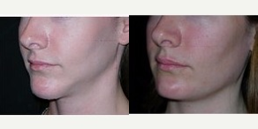 Genioplasty before and after photo