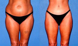 Liposuction before and after photo