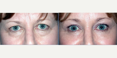 Brow Lift before and after photo