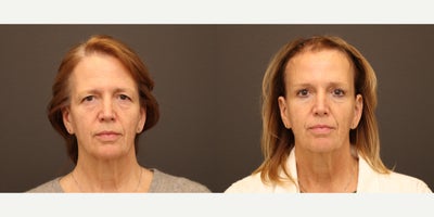 Brow Lift before and after photo