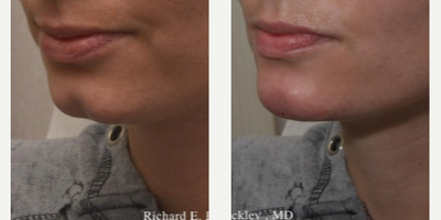 Dermal Fillers before and after photo