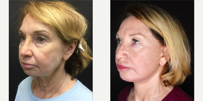 Facelift before and after photo