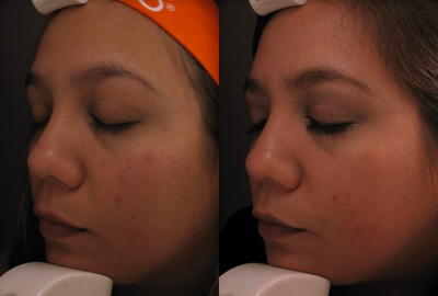 Fractional Laser before and after photo