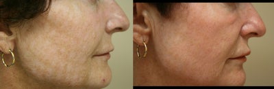Fraxel Laser before and after photo