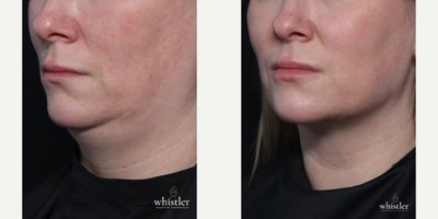 Kybella before and after photo