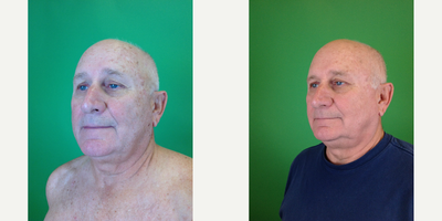 Laser Resurfacing before and after photo