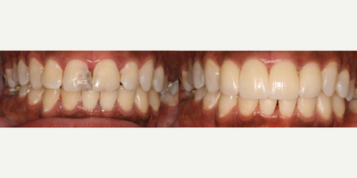 Porcelain Veneers before and after photo