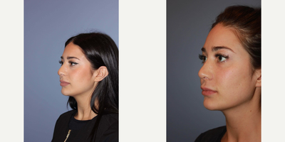Revision Rhinoplasty before and after photo