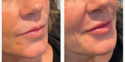 Dermal Fillers before and after photo