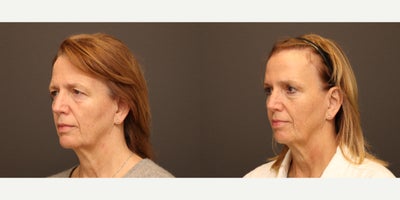Eyelid Surgery before and after photo