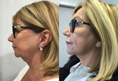 Facelift before and after photo