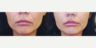 Juvederm before and after photo