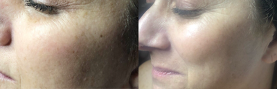 Microneedling before and after photo