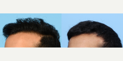 NeoGraft before and after photo