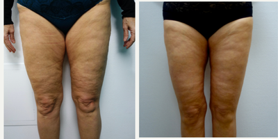 Thigh Lift before and after photo