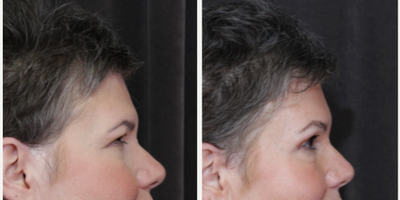 Brow Lift before and after photo