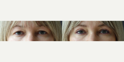 Eyelid Surgery before and after photo