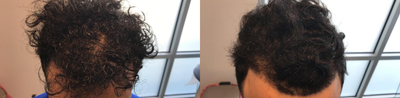 PRP for Hair Loss before and after photo
