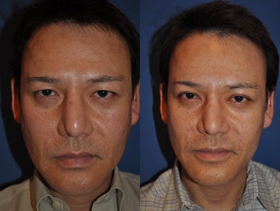 Brow Lift before and after photo