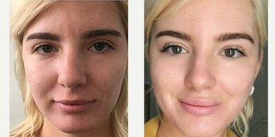 Chemical Peel before and after photo