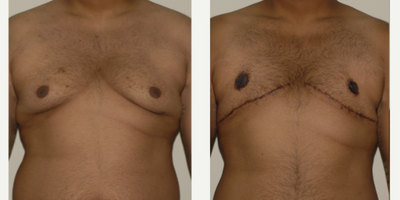 Gynecomastia Surgery before and after photo