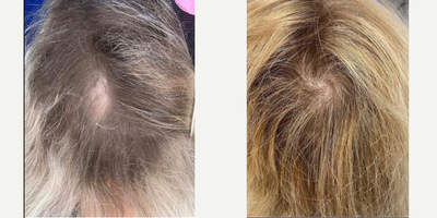 Hair Loss Treatment before and after photo