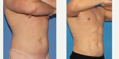 Liposuction before and after photo