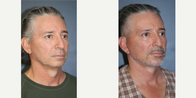 Neck Lift before and after photo