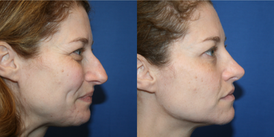 Revision Rhinoplasty before and after photo