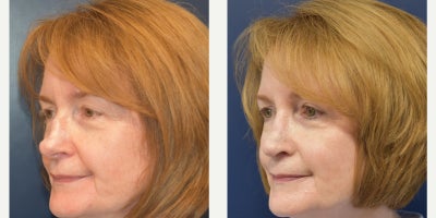 Revision Rhinoplasty before and after photo