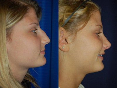 Rhinoplasty before and after photo