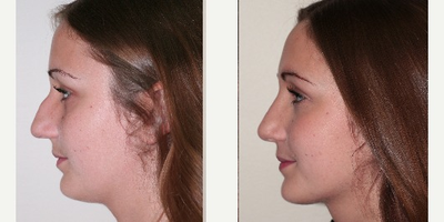 Rhinoplasty before and after photo