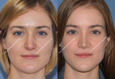 Rhinoplasty before and after photo