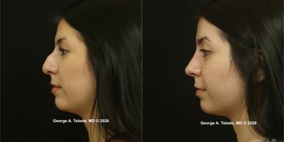 Rhinoplasty before and after photo