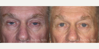 Ptosis Surgery before and after photo