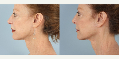 Ultherapy before and after photo