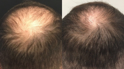 ARTAS Robotic Hair Transplant before and after photo