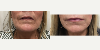Dermal Fillers before and after photo