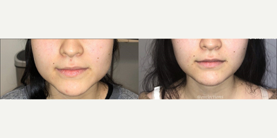 Dermal Fillers before and after photo