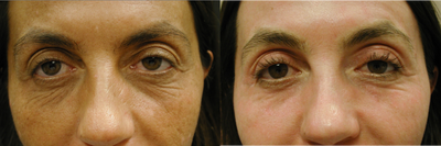Fraxel Laser before and after photo