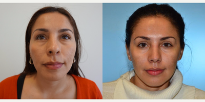 Rhinoplasty before and after photo