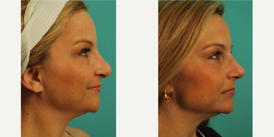 Rhinoplasty before and after photo